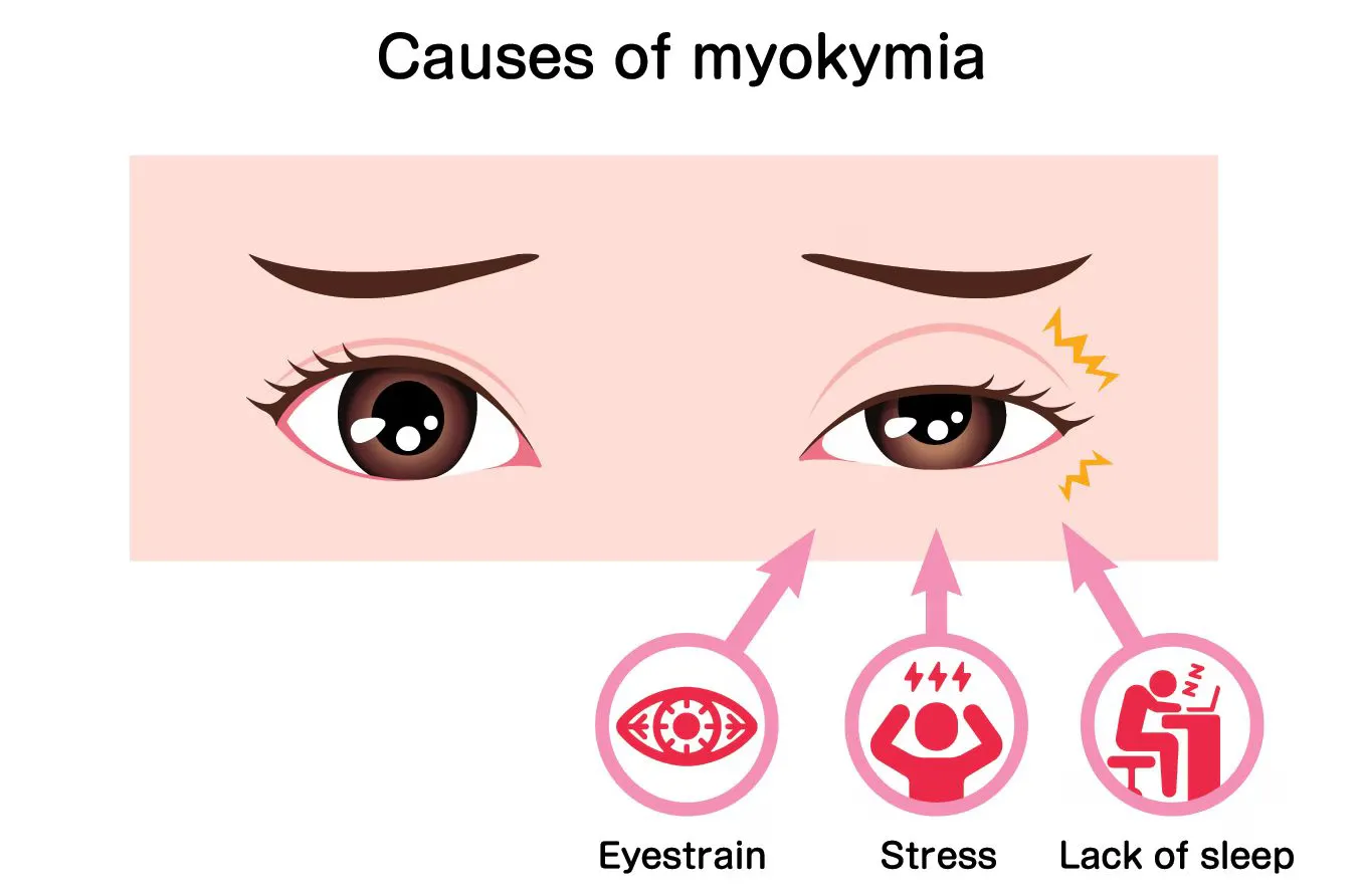 Infografis “Causes of Myokymia”